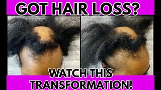 HAVE YOU TRIED THIS l PASSION TWIST l ALOPECIA l BALD SPOT COVER UP METHOD [upl. by Navada]