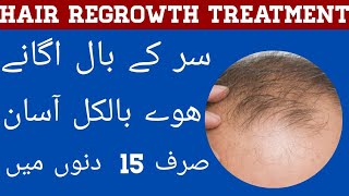 Sar Ka Ganjapan Ka Ilaj  Hair Regrowth Treatment At Home In Urdu Hindi  Hair Loss Ka Ilaj [upl. by Edelman]