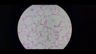 1 Diagnosed 1 Saved  Melioidosis Documentary Short [upl. by Gnilhsa]