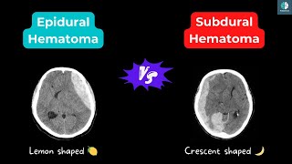 Difference between Epidural Hematoma and Subdural Hematoma [upl. by Raseda]