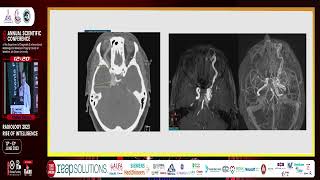 Endo Vascular Management Of Carotid  Cavernous Fistula [upl. by Balough]