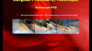 Posterolateral Endoscopic Thoracic Microdiscectomy with GPS System [upl. by Margarita178]