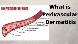 What is Perivascular Dermatitis [upl. by Icaj143]