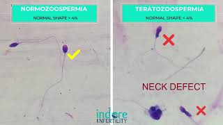 Teratozoospermia  Poor Morphology Sperms Comparison with Normal morhology sperms  Normozoospermia [upl. by Borchert]