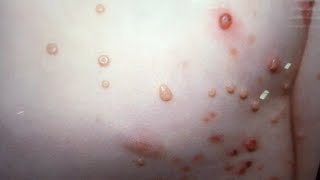 Molluscum Contagiosum PopTALK Dermatology diagnosis discussion [upl. by Landing]