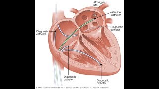 Tratamiento de arritmia ablación cardïaca por radiofrecuencia [upl. by Lapham]