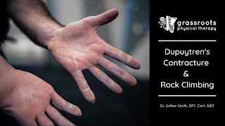 Dupuytrens Contracture and Rock Climbing [upl. by Nole]