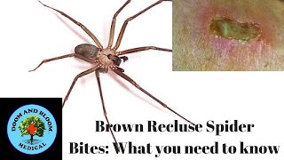 Brown Recluse Spider Bites What you need to know [upl. by Amaryllis724]