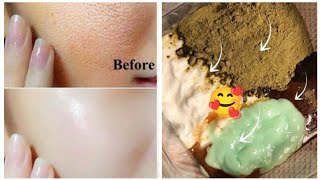 intan iskuqas doldoolel ka wajiga 👍🏻 remove acne in 7 days [upl. by Ahtreb]