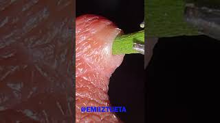 Splinter Removal super fast Satisfying 100 [upl. by Lemra]