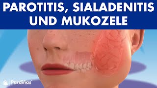 MUMPS Parotitis und andere Speicheldrüsenprobleme Sialadenitis Sialolithiasis Mukozele © [upl. by Renick]