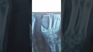 scaphoid fracturefracture wrist fracture anatomy osteology doctors mbbs medical [upl. by Ecerehs]