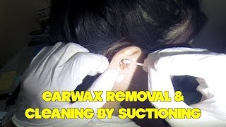 Earwax Removal amp Cleaning by Suctioning [upl. by Danya586]