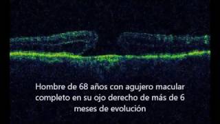 Cirugía de agujero macular  Nueva técnica con inducción de desprendimiento macular [upl. by Kieryt]