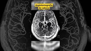 ANGIOTOMOGRAFÍA DE CABEZA [upl. by Haleigh]