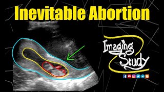 Inevitable Abortion  Ultrasound  Case 208 [upl. by Ahseinad]