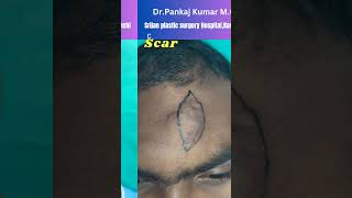 Scar revision surgeryScar treatment in Ranchi Shorts scar [upl. by Aniroc904]