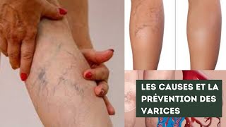 Comment prévenir et traiter les varices et les varicosités [upl. by Yehudi75]