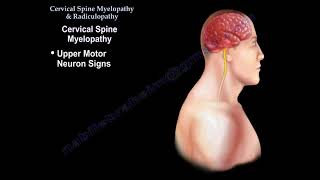 Cervical Spine Myelopathy amp Radiculopathy [upl. by Anirpas]