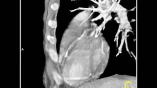 Vascular Diseased LAD 3D and 4D mapping of the coronary CT angiogram1 of 2 [upl. by Assek]