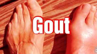 Gout Biochemistry  Types of Gout Treatment of Gout Hyperuricemia [upl. by Fortunia]