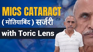 MICS Cataract Surgery With Toric Lens [upl. by Aneel]