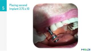 Implantation Procedure using MSDI dental implants Alef Implant  by Dr Raul Rojas [upl. by Ynnaej]