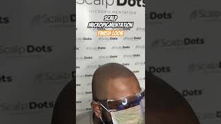 Scalp micropigmentation finish look scalpmicropigmentationindia hair scalpmicropigmentation [upl. by Flore]