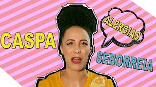 Alergia no couro cabeludo  Minha experiência [upl. by Elleral296]