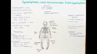 Hypophosphatemic Rickets Xlinked Hypophosphatemia Vitamin D resistant Rickets [upl. by Alyel]