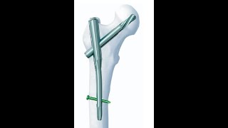 Proksimal femur çivisi  Proximal femoral nail [upl. by Neerol970]