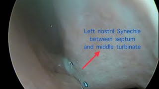 Synechiae release under local anesthesia [upl. by Kimberlyn800]