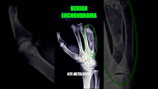 Enchondroma bones xray health [upl. by Occor]