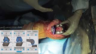 Measured Resection Approach in TKA with Joseph Locker MD [upl. by Gniw]