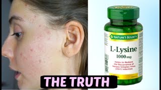 I TOOK LYSINE FOR 2 WEEKS STRAIGHT THIS IS WHAT HAPPENED TO ACNE SCARS [upl. by Aldwon]