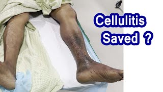 cellulitis infection  Necrotizing Fascitis Healing Stages [upl. by Koetke]