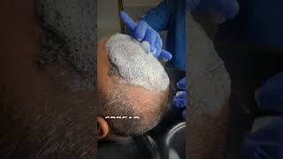 1st Head Wash After 10 Days of Hair Transplant  Post Care [upl. by Kariv]