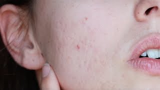 ACNE DIARY Settimo Mese con Isotretinoina LA FINE [upl. by Decrem]