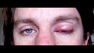 How To Get Rid Of A Stye  how to get rid of styes  eye stye treatment [upl. by Donaghue227]