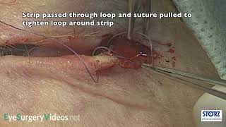 Lateral tarsal strip alternative suturing technique [upl. by Balas]