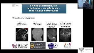 06 NeuroRadiologie Interventionnelle chez l’enfant [upl. by Torrlow719]