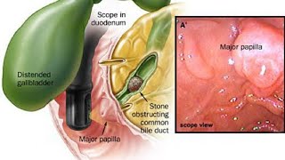 Cholecystitis Dr Fady Magdy افضل وأوضح شرح لألتهاب المراره د فادي مجدي [upl. by Oelc187]