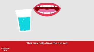 How To Treat a Gum or Tooth Abscess  Colgate® [upl. by Burch591]