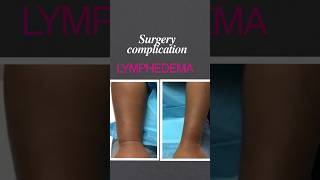 BC surgery complicationlymphedema cancerwarrior help youtubeshorts inspiration cancertherapy [upl. by Car]