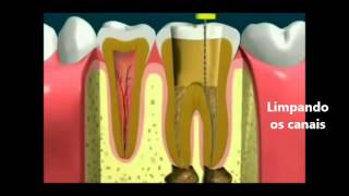 O que é Endodontia [upl. by Callie802]