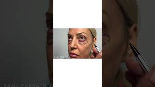 Lower Eyelid Blepharoplasty After Removing Tear Trough Filler  Dr Kami Parsa [upl. by Vite268]