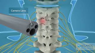 What is Endoscopic Posterior Cervical Discectomy and Foraminotomy AtlanticSpineCenter [upl. by Rednas817]