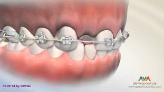 Orthodontic amp Restorative Treatment for Missing Lateral Incisor  Different Options [upl. by Marshall930]