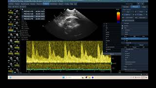 IQ 302 TCD BRAIN ICP CPP ECHOPAC ANALYSIS ULTRASOUND 2 [upl. by Nerual576]