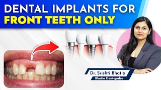 Dental Implants for FRONT TEETH only Dr Srishti Bhatia implants dentist newteeth [upl. by Togram]